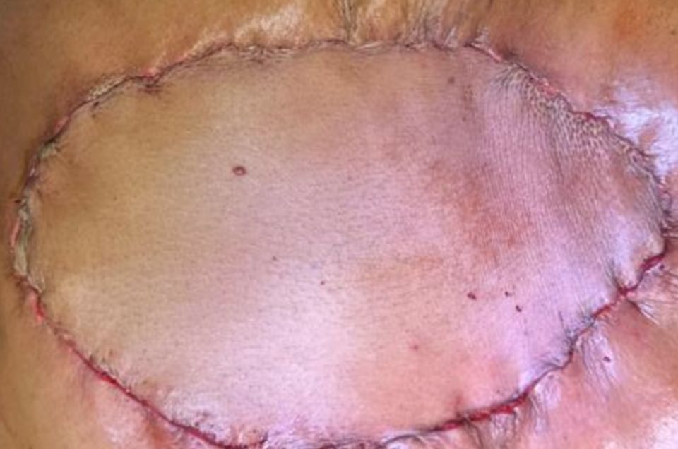 Coonar thoracic immediate post-op.jpg
