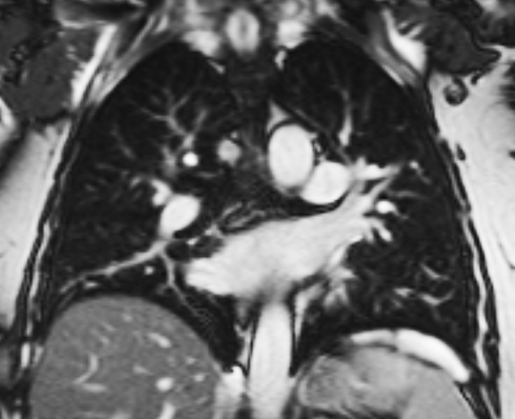 Black and white photo of MRI Scan showing internal organs