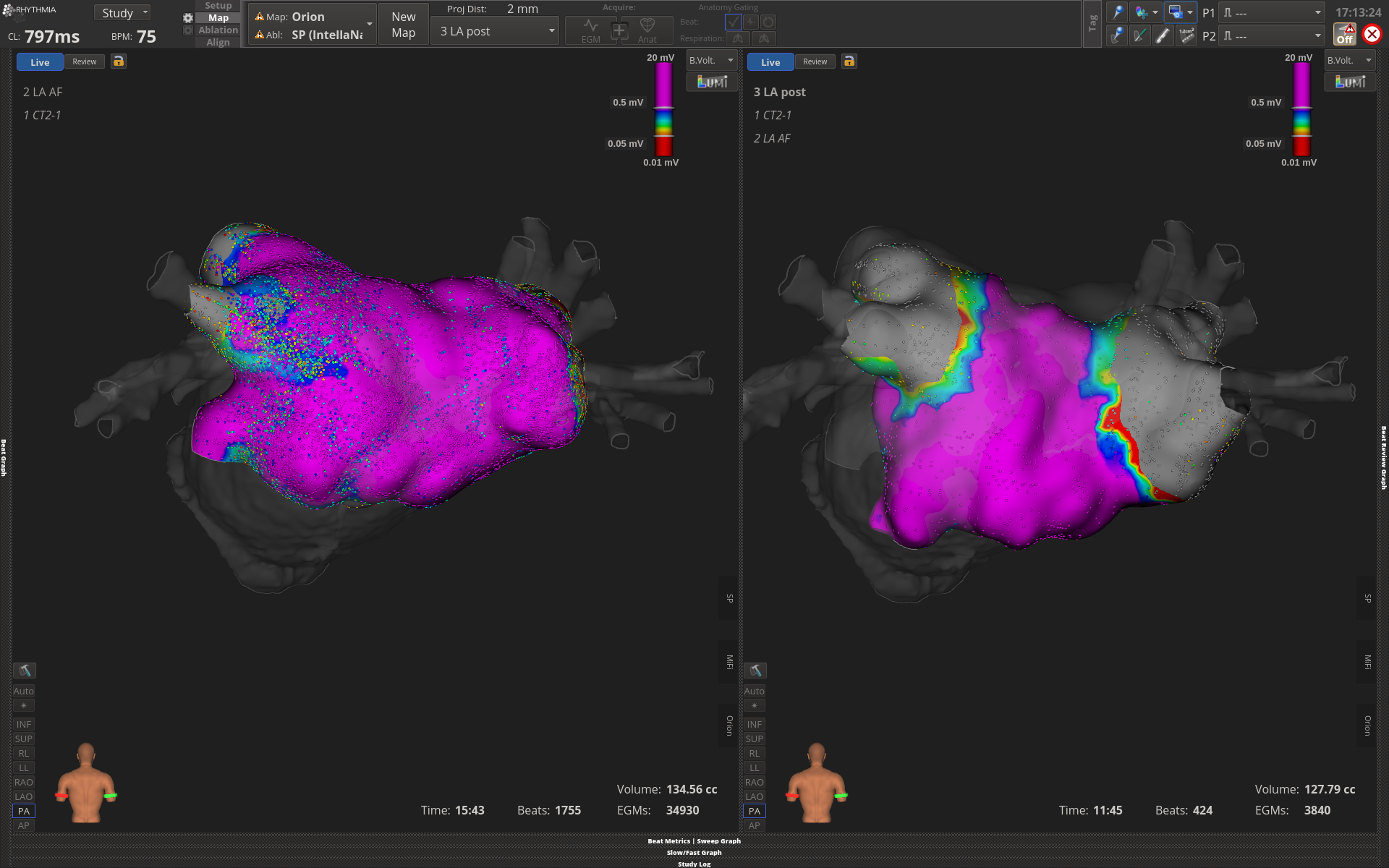 Heart maps on a screen, one on the left covered in purple and one of the right with less purple. 