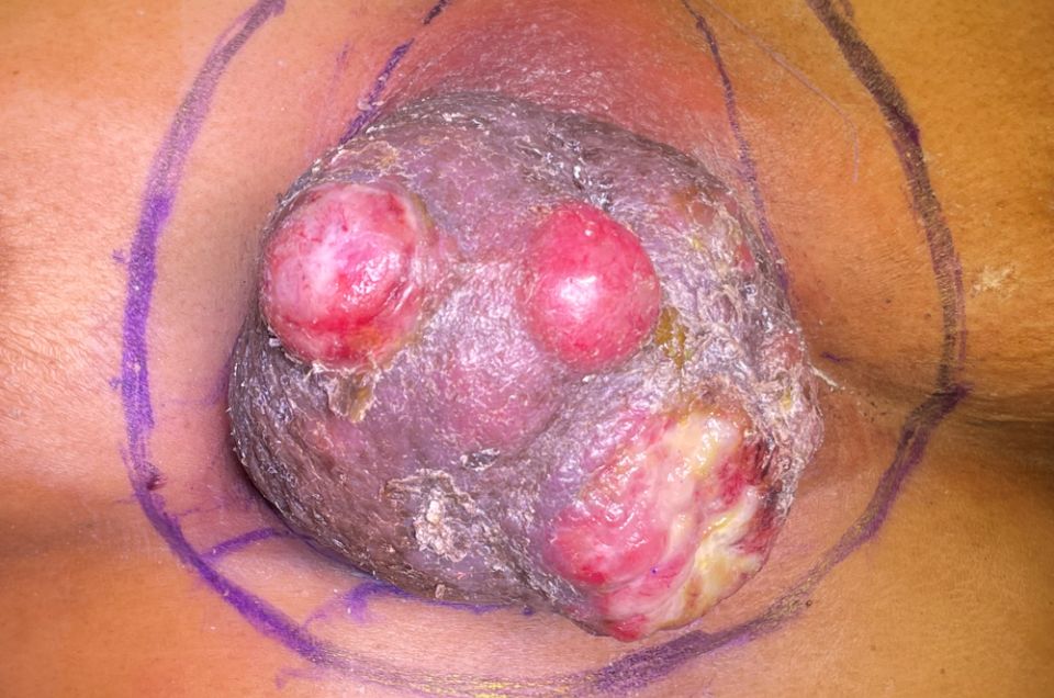 Coonar thoracic immediate day of surgery.jpg