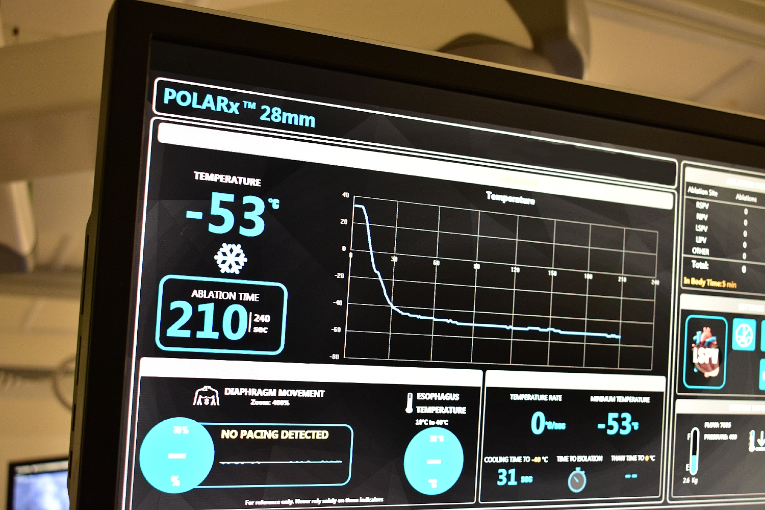 A screen showing that the cryoballoon device has been cooled to minus 53 degrees Celsius.jpg