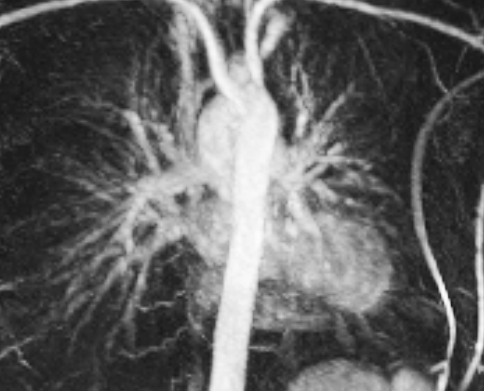 Black and white photo of anggiogram showing internal organs