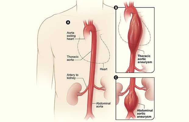 aortic aneurysm diagram.jpg